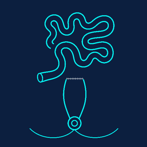 Stage 1: the colon is removed and the rectum is retained