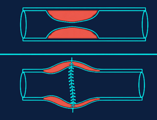 Before (top): a narrowed stricture pinching the bowel closed. After (bottom): the same segment widened with a crosswise suture line, with no intestine removed.